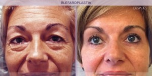 Before and after image of a eye lift procedure.